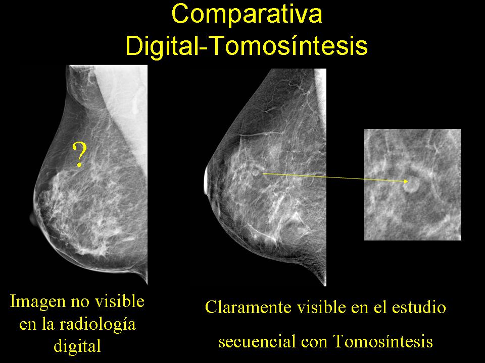 comparativa digital-tomosíntesis